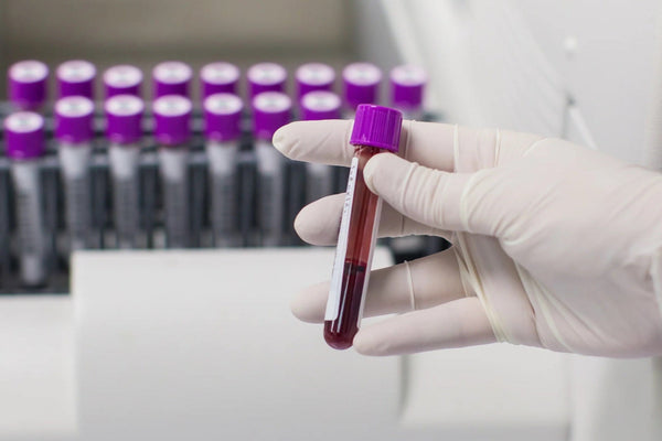 Alzheimer-kór kockázati teszt -  Foszforilált tau (p-tau181) biomarker